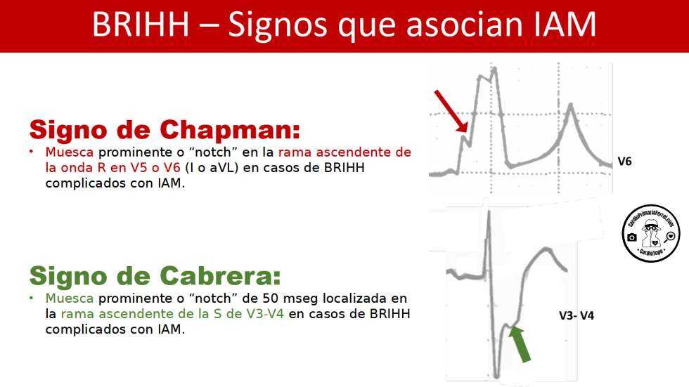 CardioTruco Signos De Chapman Y Cabrera Cardioprimaria Ferrol