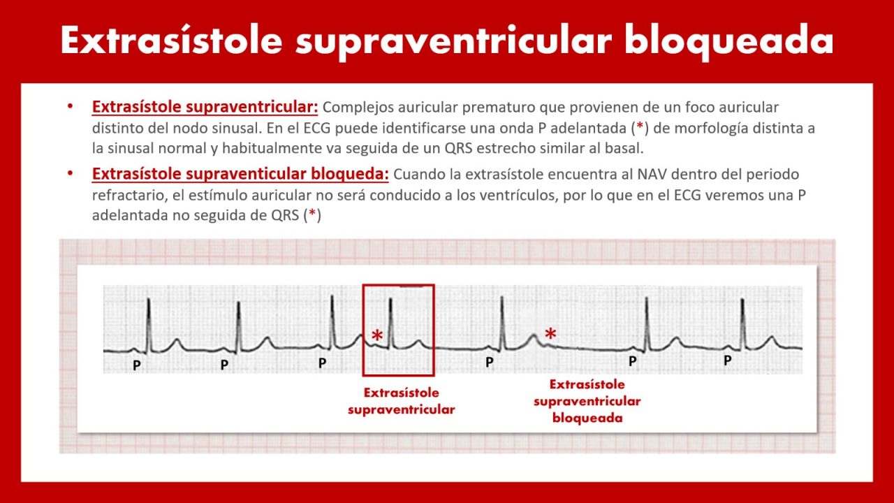 CardioTruco extrasístoles supraventriculares Cardioprimaria Ferrol