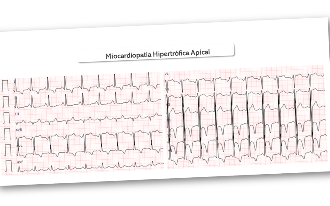 Miocardiopatía hipertrófica apical