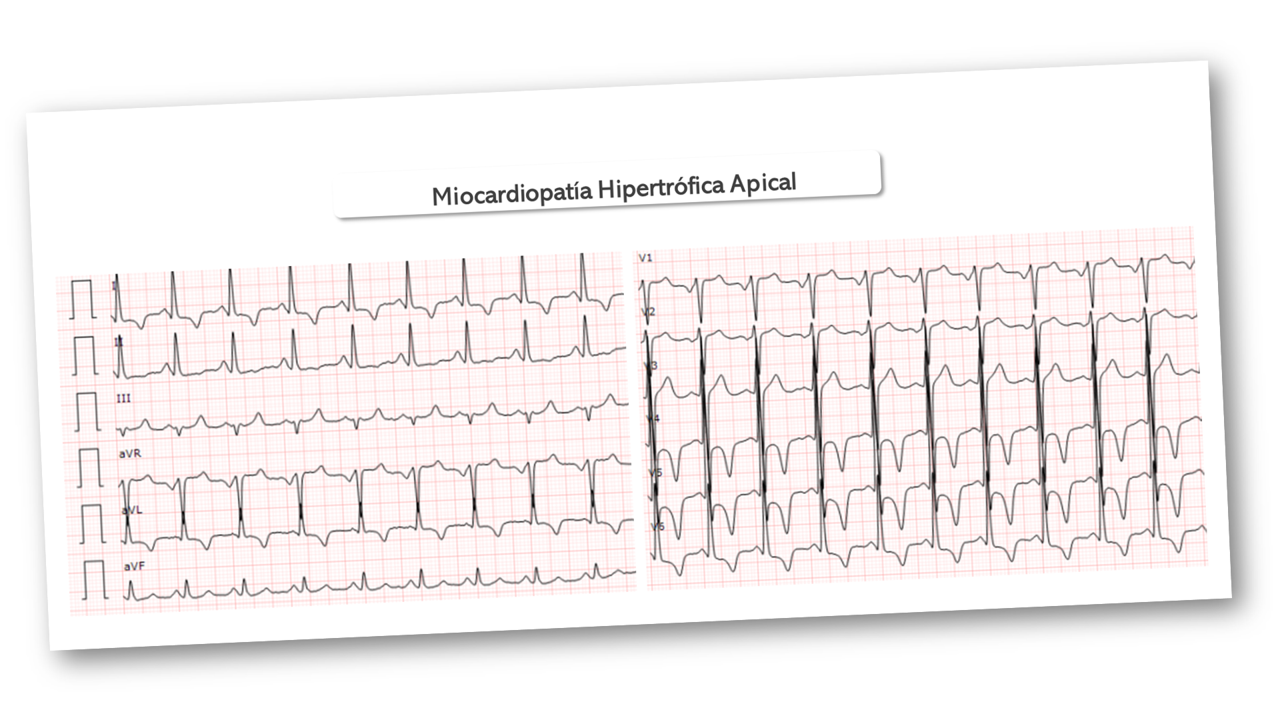 Miocardiopatía hipertrófica apical