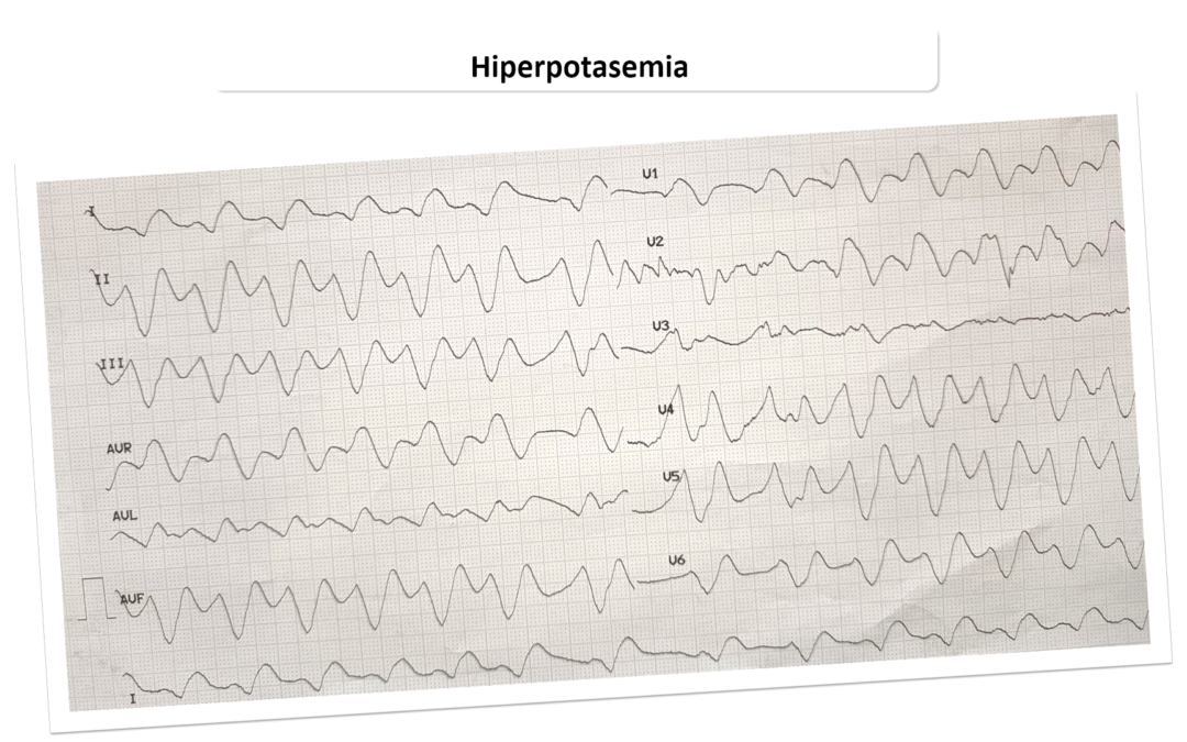 Trastorno del ritmo secundario a hiperpotasemia