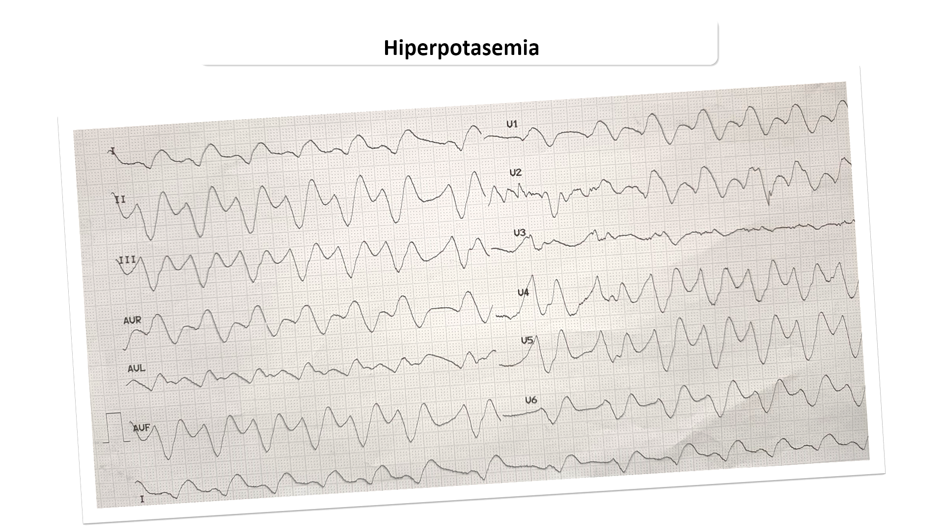 Trastorno del ritmo secundario a hiperpotasemia