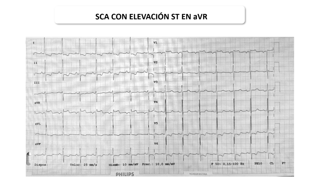 SCA, elevación de ST en aVR