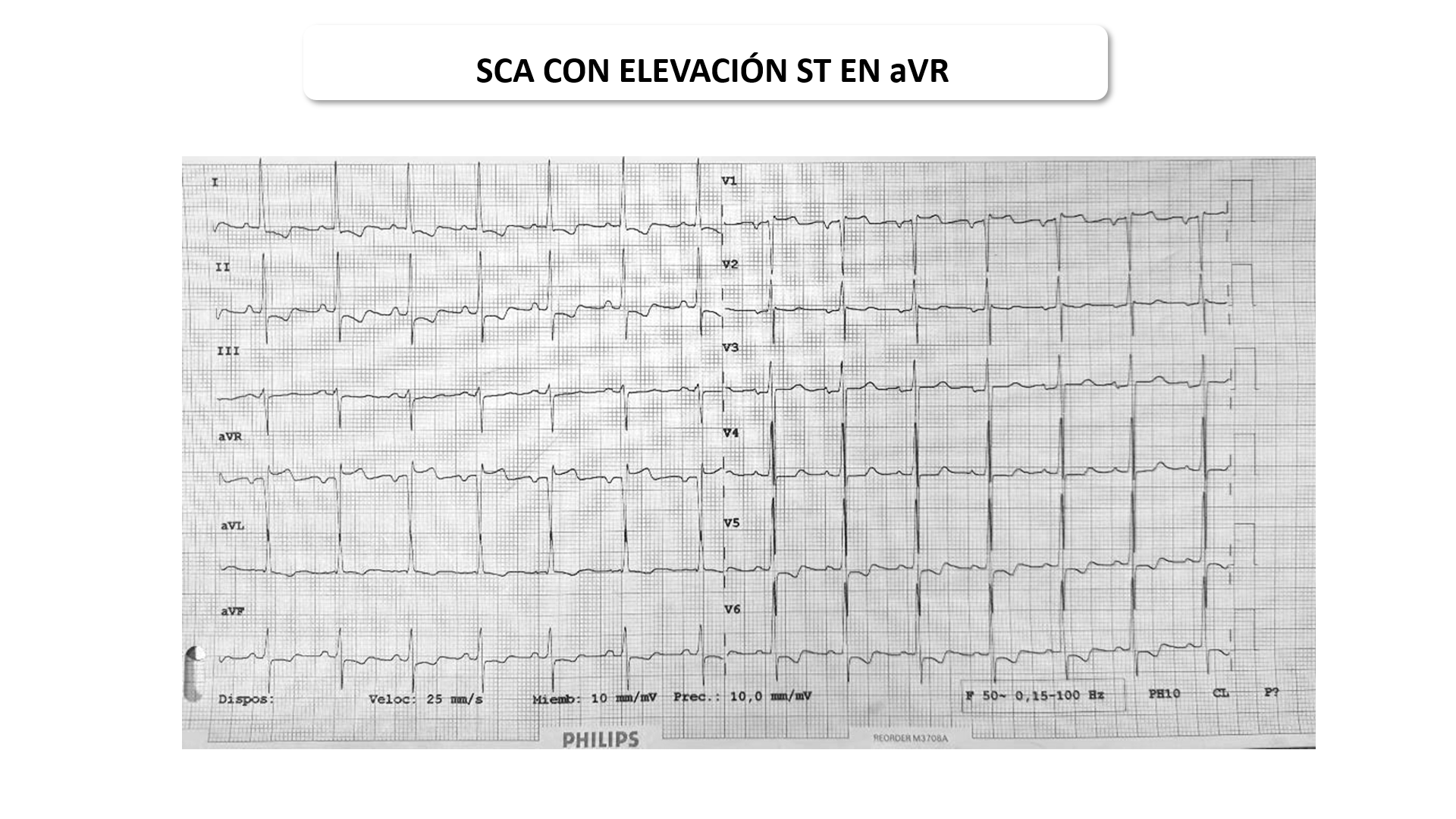 SCA, elevación de ST en aVR