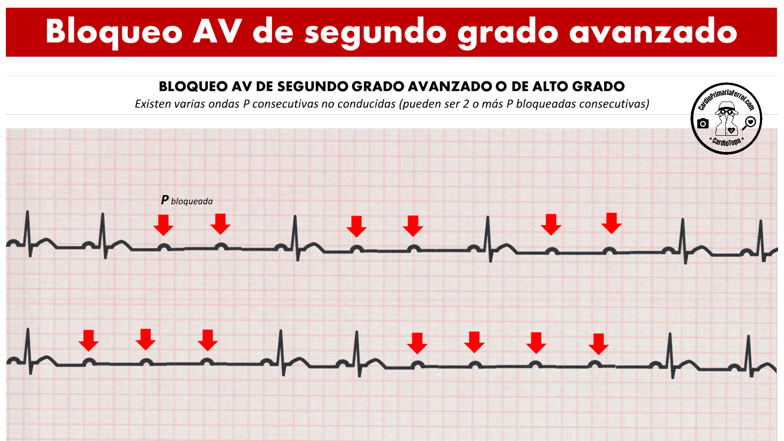 Electrocardiograma De Bloqueo Card aco De Segundo Grado