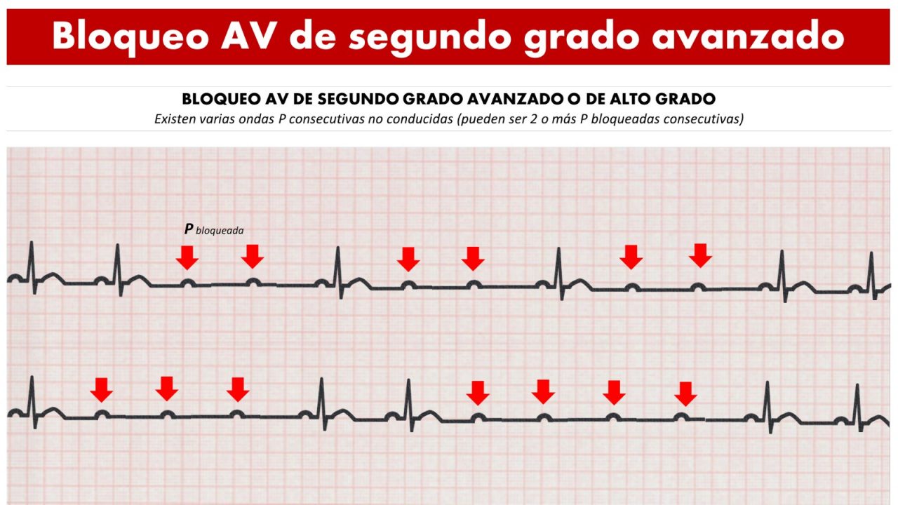 CardioTruco: Bloqueos AV - Cardioprimaria Ferrol