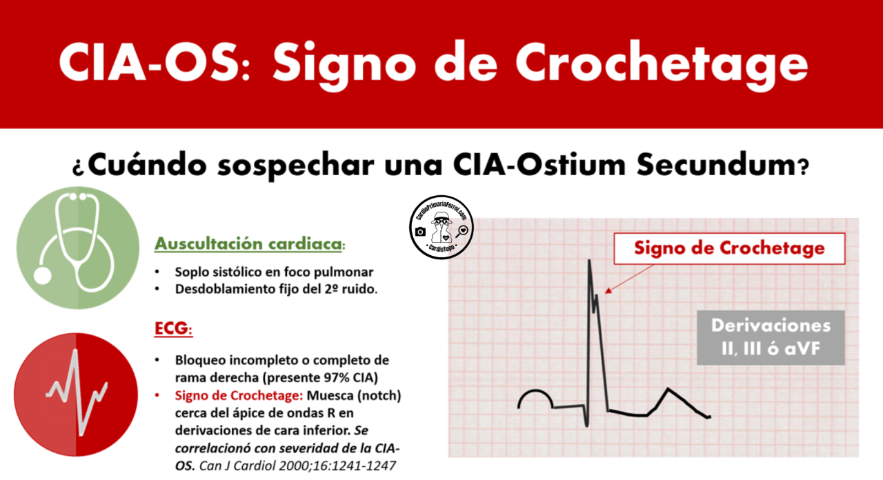 CardioTruco: signo de Crochetage - Cardioprimaria Ferrol